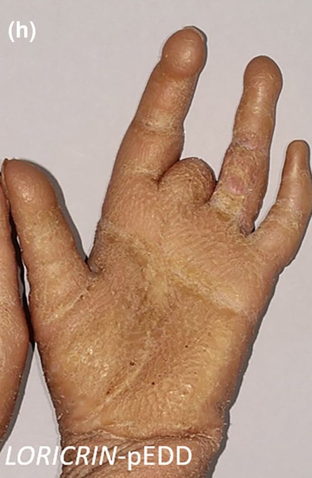 LORICRIN-pEDD: diffuse palmar keratoderma with honeycombing, pseudoainhum of the fingers and autoamputation of the third finger.