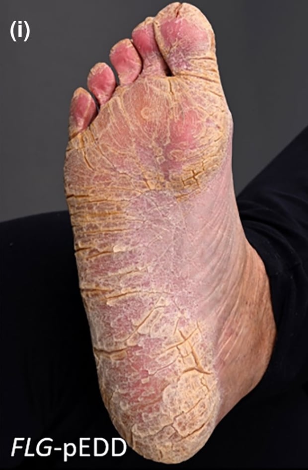FLG-pEDD: diffuse plantar keratoderma with xerosis, fissuring and erythema.