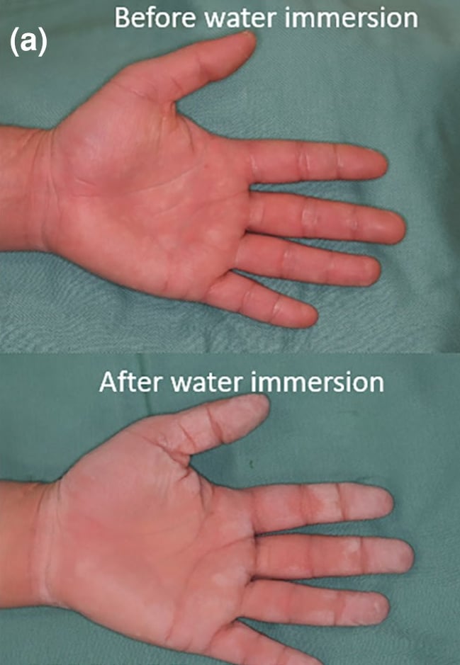 SERPINB7-pEDD: the upper panel before immersion in water shows typical mild, diffuse, erythematous palmar keratoderma; the lower panel shows a white, spongy appearance after immersion in water.