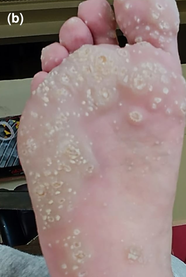 AAGAB-pEDD: punctate papules coalescing into focal plantar plaques.
