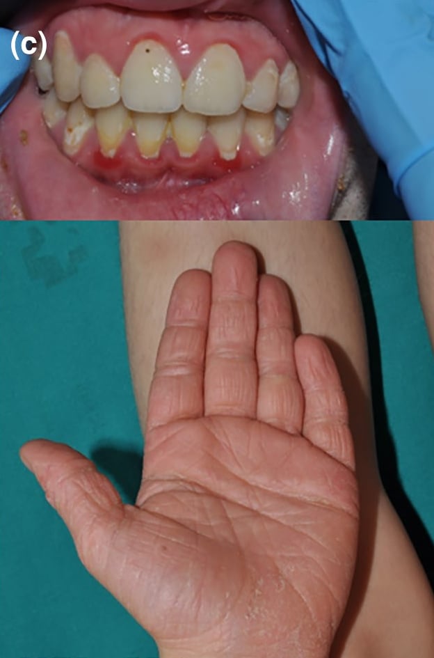 CTSC-pEDD: diffuse, erythematous keratoderma with gingival erythema.