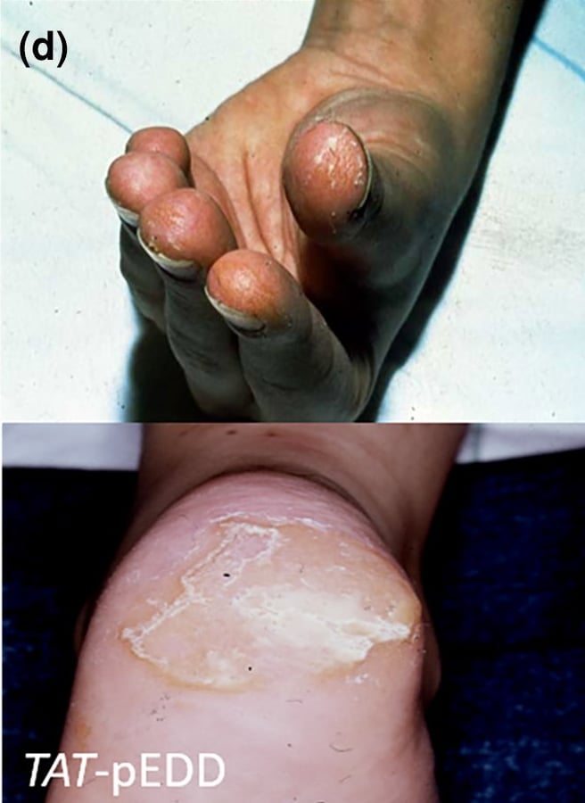 TAT-pEDD: fingertip hyperkeratosis following the dermatoglyphics and well-demarcated focal, plantar calluses.