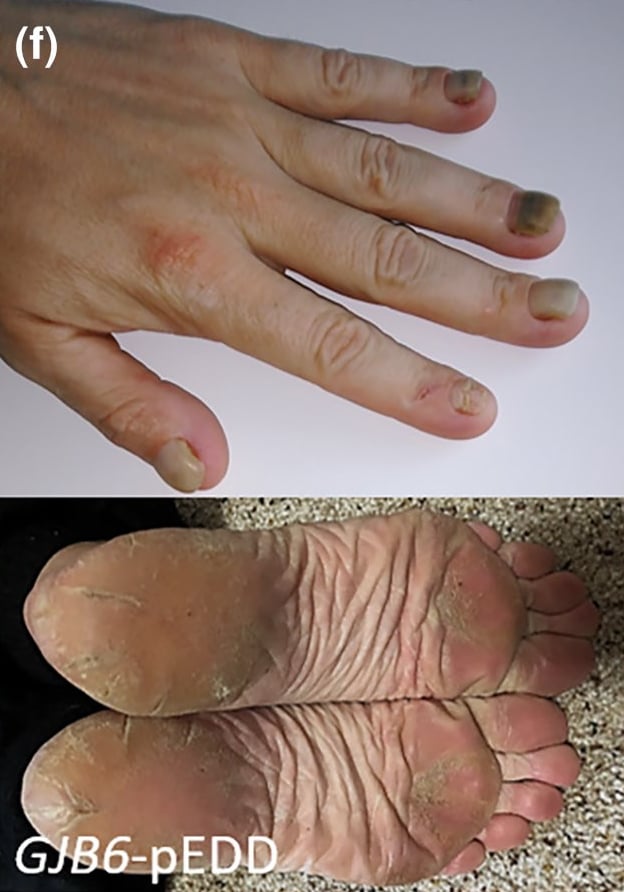 GJB6-pEDD: subungual hyperkeratosis of the fingernails and focal, plantar keratoderma.