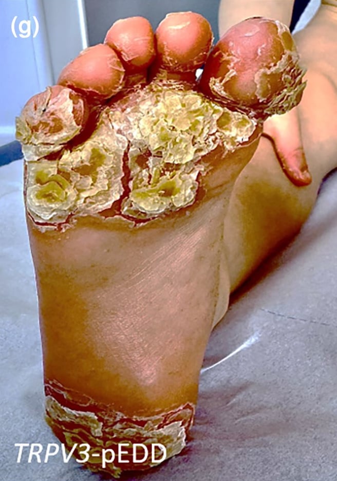 TRPV3-pEDD: mutilating, focal, plantar calluses.