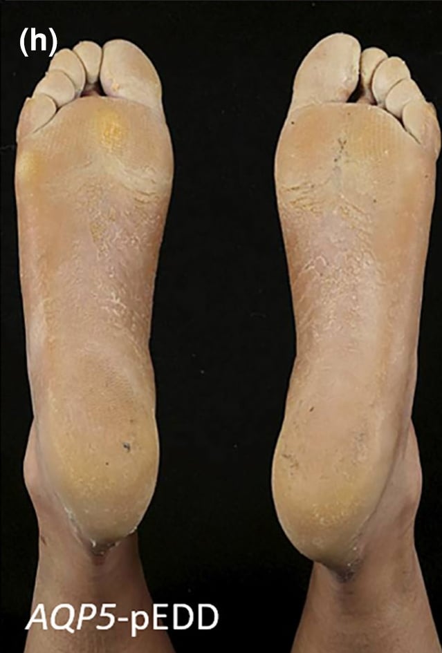 AQP5-pEDD: diffuse, plantar keratoderma with tinea pedis.