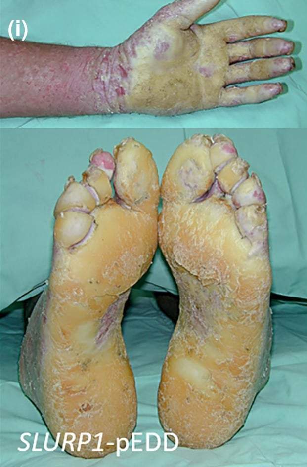 SLURP1-pEDD: diffuse, macerated, transgradient palmoplantar keratoderma.