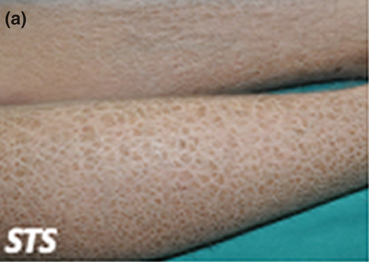 STS-sEDD: dark-brown polygonal scaling predominantly observed on the anterior aspects of the lower legs, characteristic of patients with this disorder.