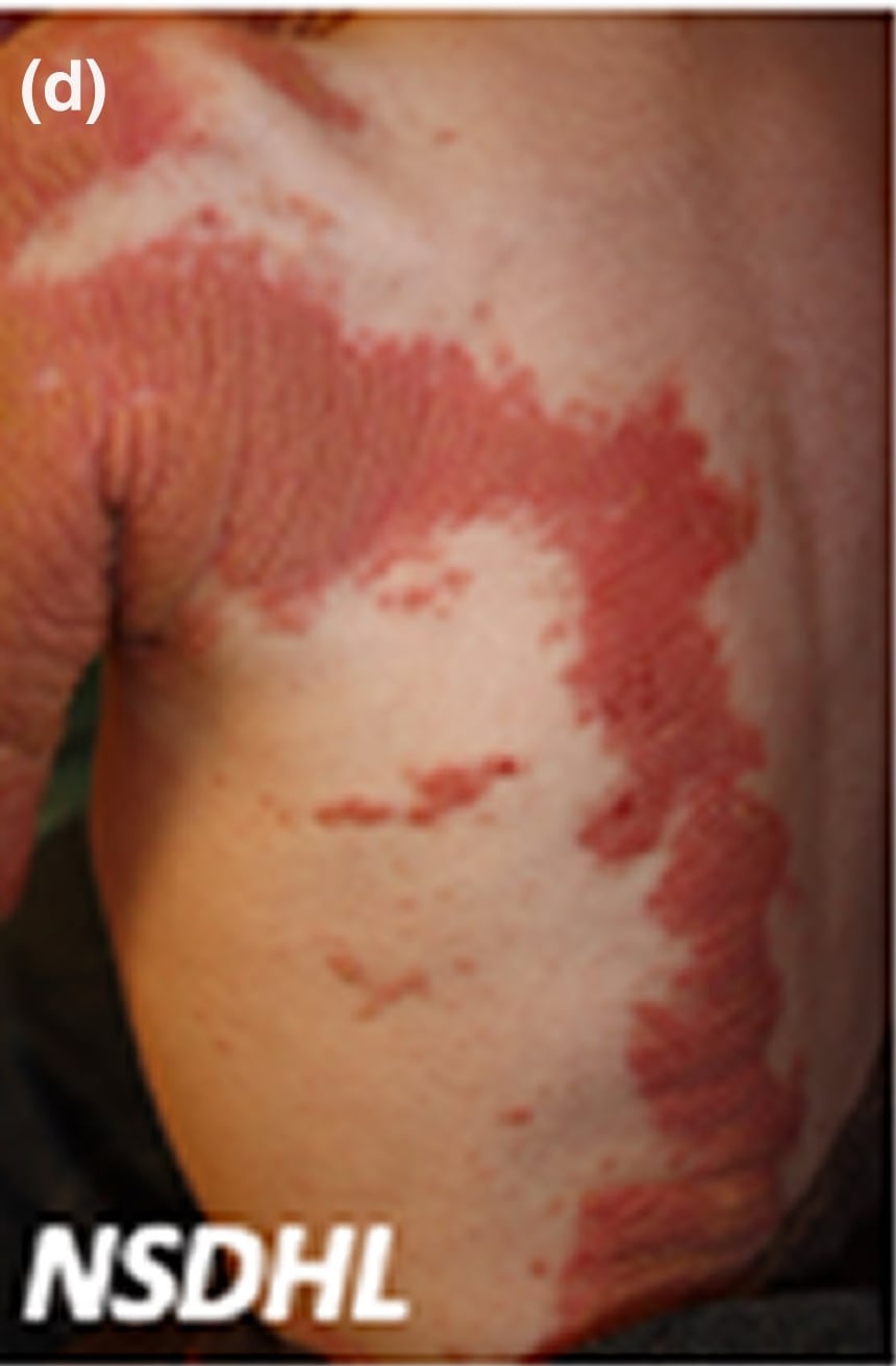 NSDHL-sEDD-CHILD: 4-year-old girl with linear red thickened plaques on the back and extending to the arm.