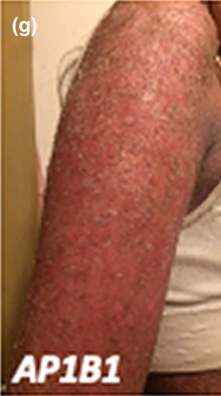 AP1B1-sEDD: 28-year-old woman with generalized erythroderma and fine scaling on the shoulder and proximal arm with accentuation at the axillary vault border.