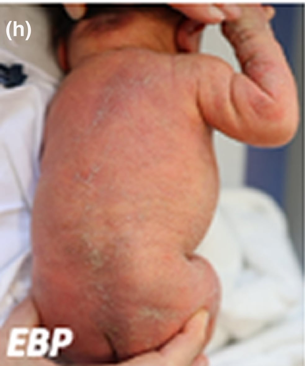 EBP-sEDD: newborn girl presenting with thick scaling along the Blaschko lines overlying truncal erythema.