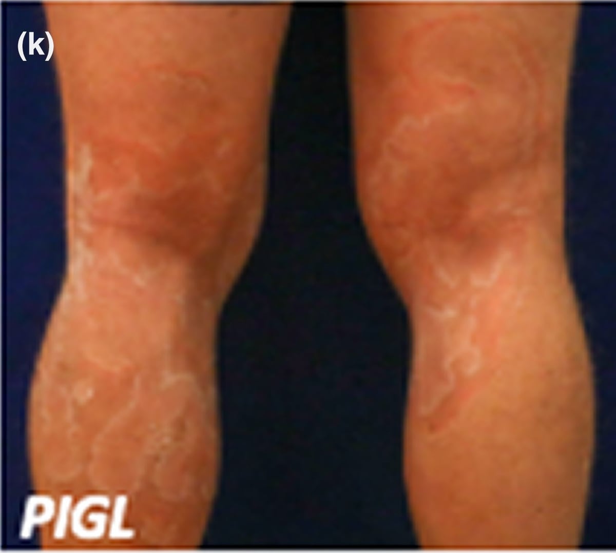 PIGL-sEDD-CHIME: sharply marginated and figurate erythematous plaques on the posterior aspects of the lower legs in an adolescent boy.