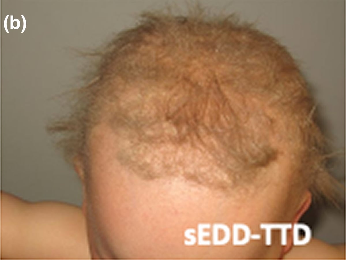 ERCC3/XPB-sEDD-TTD: sEDD-TTD (unspecified-sEDD-TTD): sparse and brittle hair in a young child.