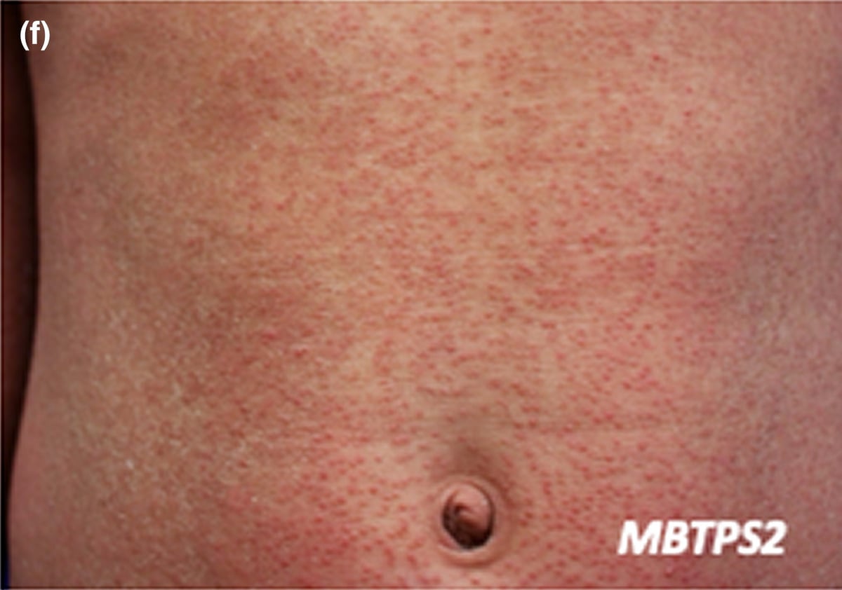 MBTPS2-sEDD-IFAP: erythematous to skin-coloured follicular-based papules are a characteristic cutaneous feature.