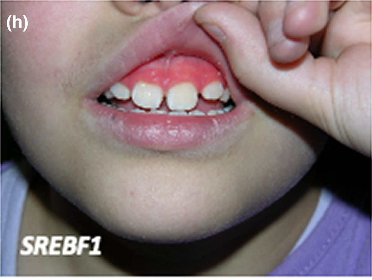 SREBF1-sEDD: typical bright red gingiva.