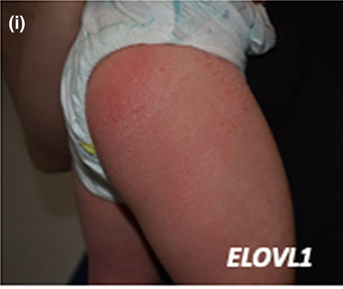 ELOVL1-sEDD: young girl with pruritic erythrodermic and scaling skin related to a heterozygous ELOVL1 c.494C > T (p.Ser165Phe) pathogenic variant (autosomal dominant).