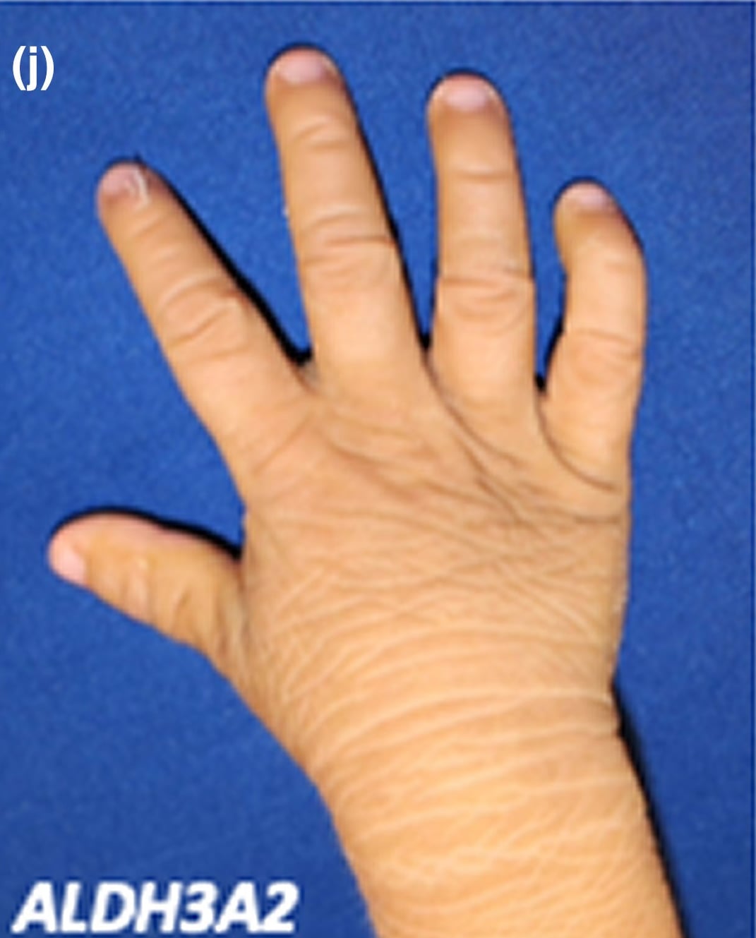 ALDH3A2-sEDD: the dorsal aspect of the hands and fingers shows leathery cutaneous thickening and a yellow hue.