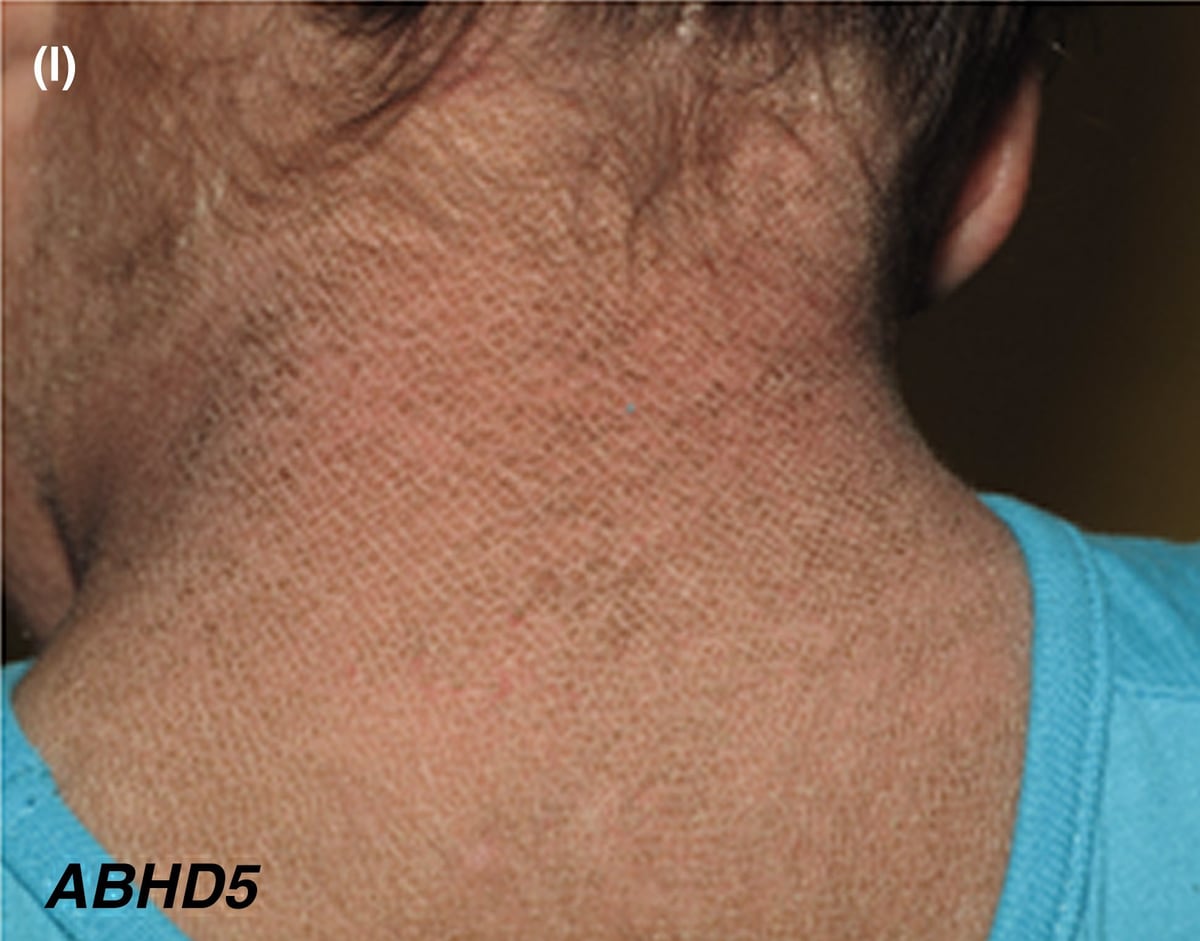 ABHD5-sEDD: skin thickening and greyish hyperpigmentation on the neck of a young girl.