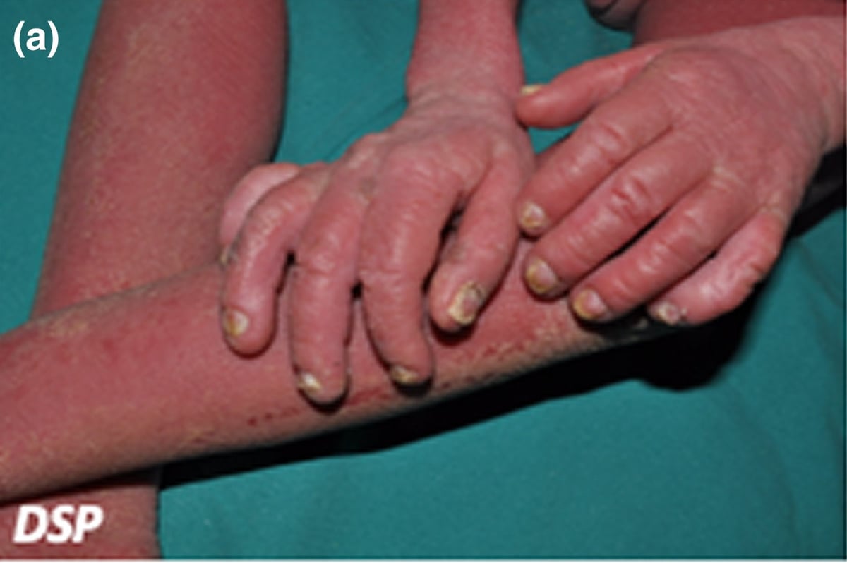 DSP-sEDD: severe erythema and diffuse yellowish thickened skin on all extremities with thickened and dystrophic fingernails.