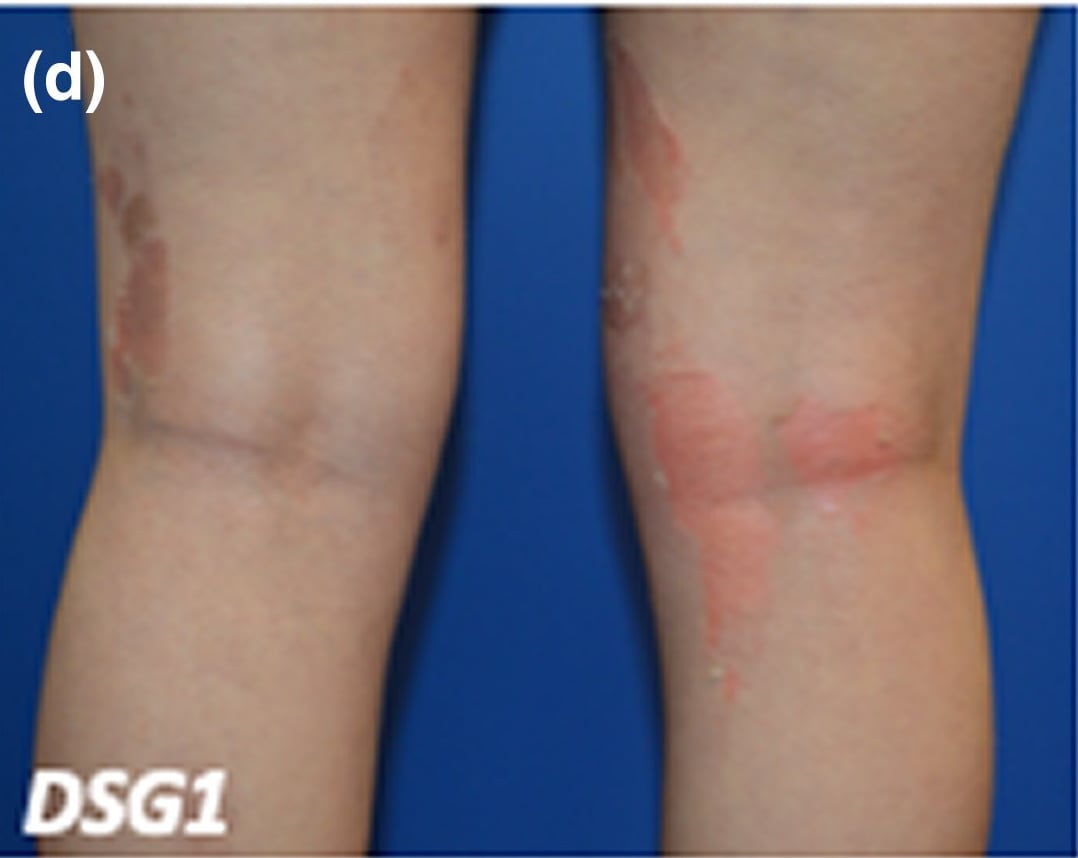 DSG1-sEDD: superficial desquamation revealing underlying erythema on the legs of a young girl.