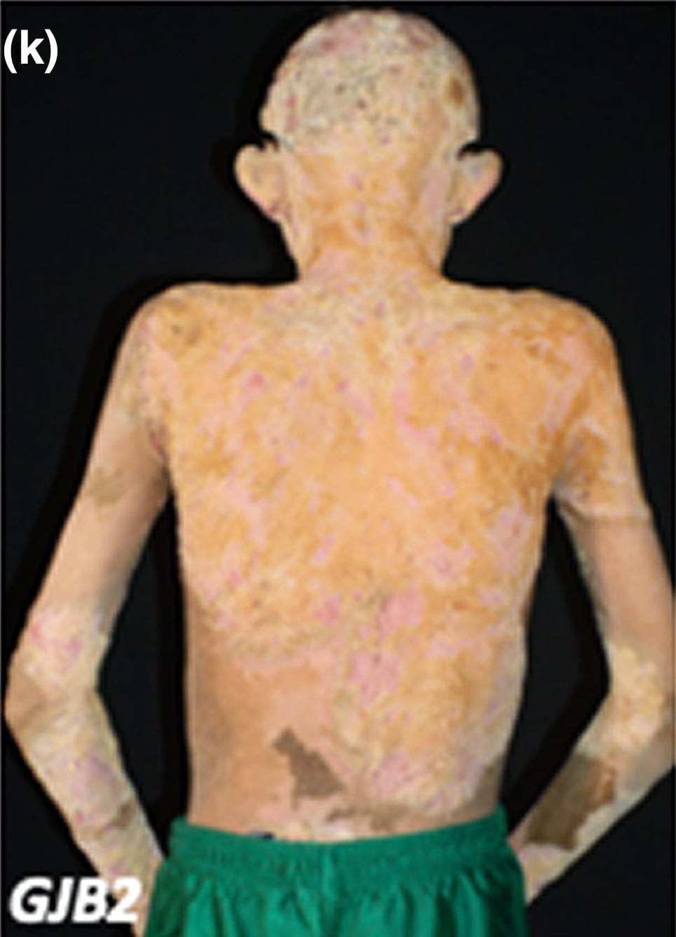 GJB2-sEDD-KID: 15-year-old boy with alopecia, as well as widespread erythema and thick scaling plaques, accentuated at flexural areas.