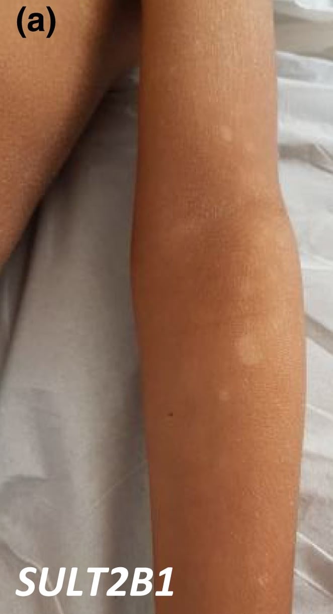 SULT2B1-nEDD: dry, scaly skin and postinflammatory hypopigmentation.