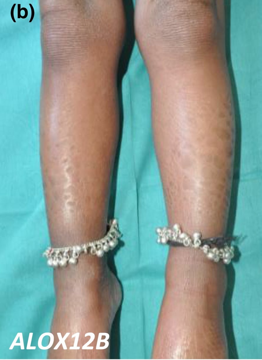ALOX12B-nEDD: large adherent scales on the anterior aspects of the lower legs in a patient with a darker skin phenotype.