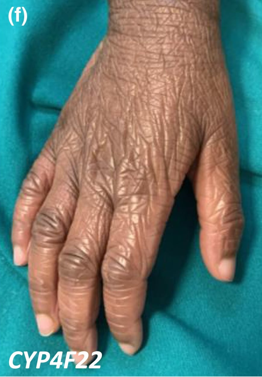 CYP4F22-nEDD: skin thickening and scaling on the dorsum of the hand.