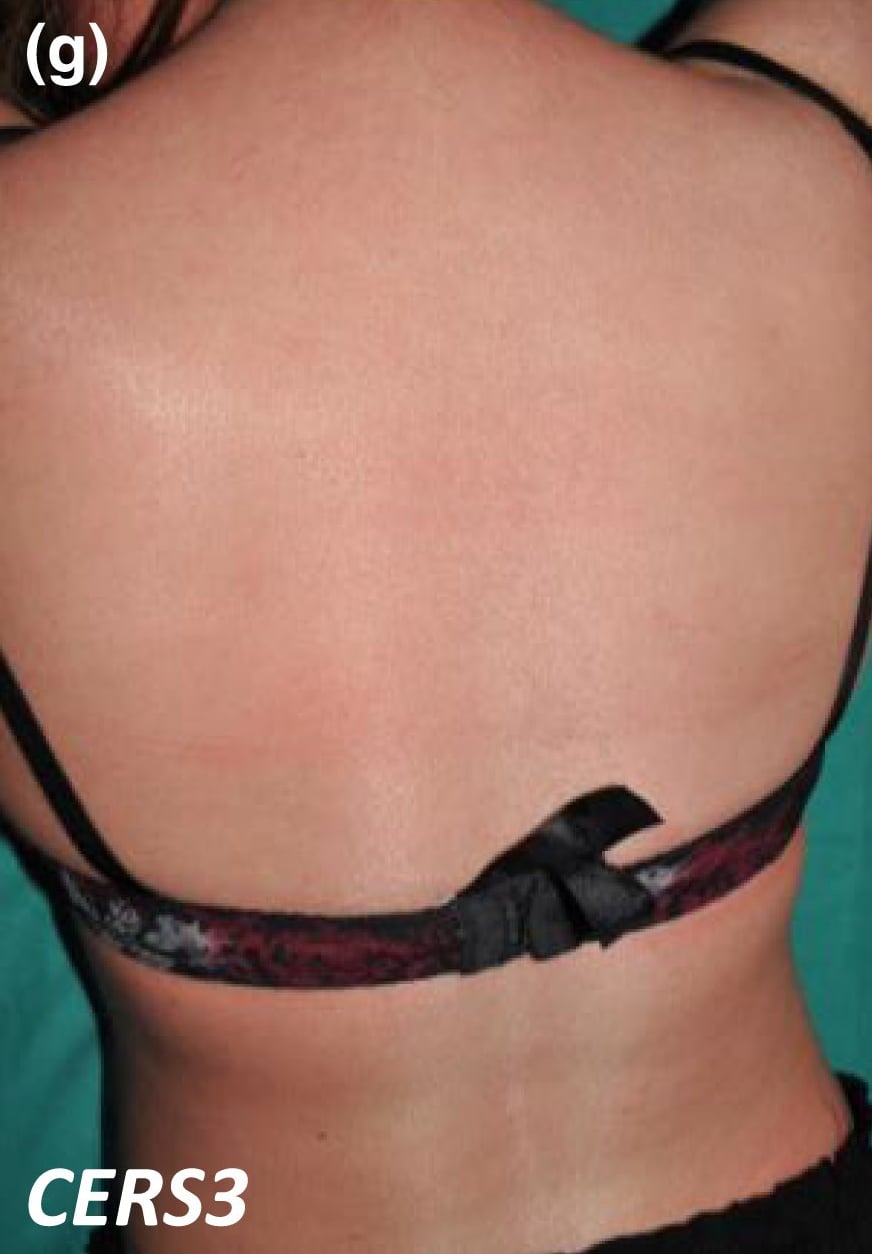 CERS3-nEDD: erythroderma with minimal scaling.