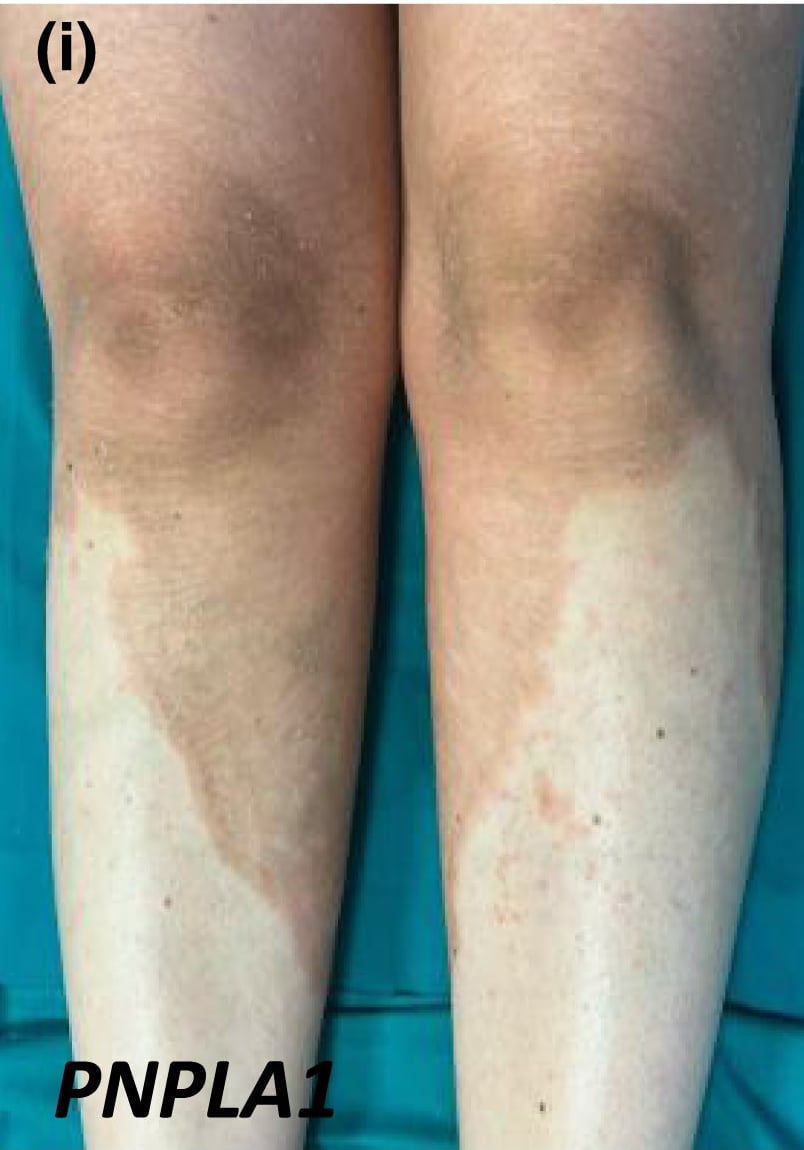 PNPLA1-nEDD: sharply demarcated scaly erythema on the legs (formerly known as erythrokeratodermia variabilis et progressiva).