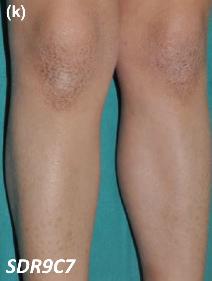 SDR9C7-nEDD: brownish-hued scales on the anterior legs and knees.