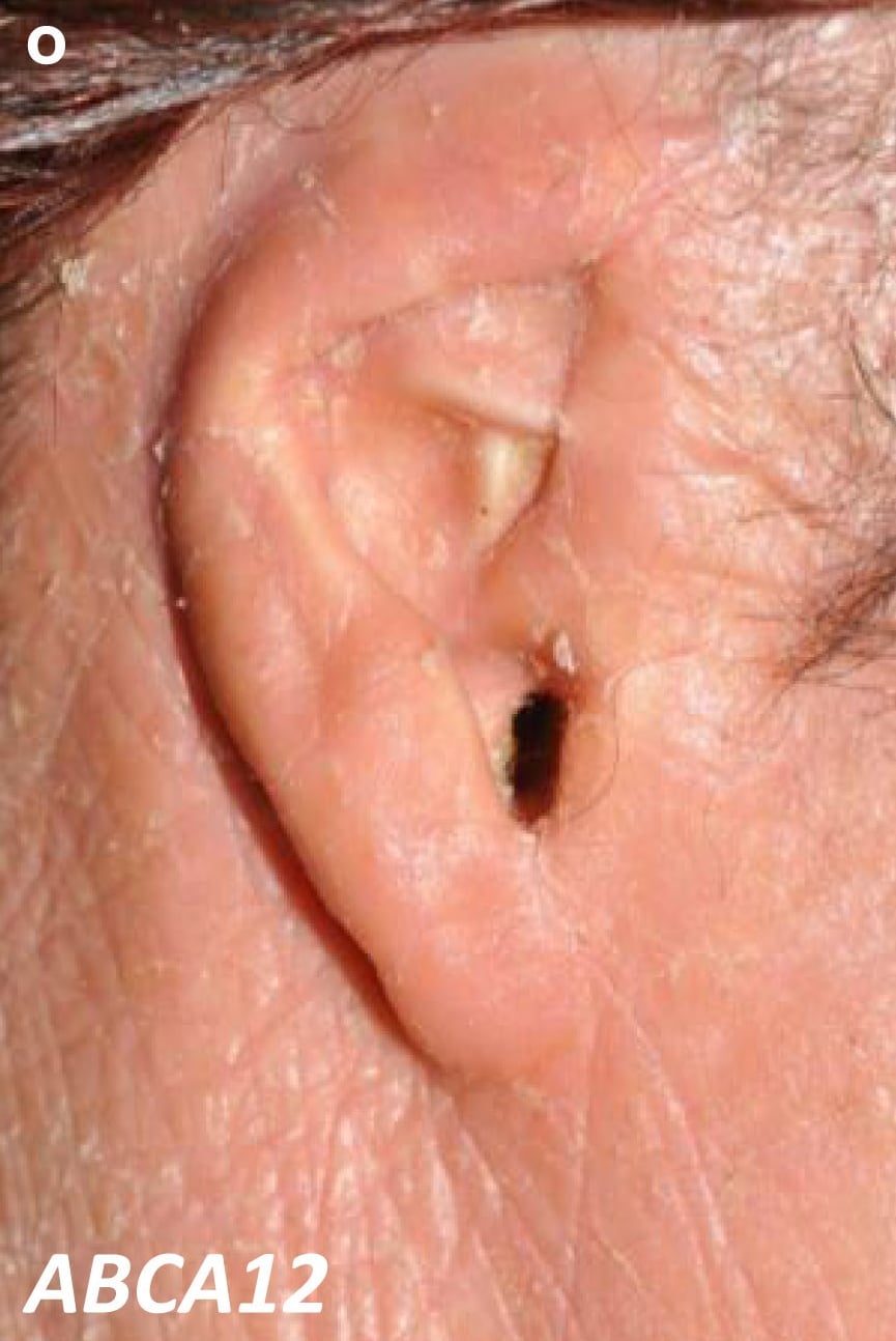 ABCA12-nEDD: ear deformity showing fusion of the retroauricular fold, resulting in an underfolded pinna accompanied by erythema and scaling.