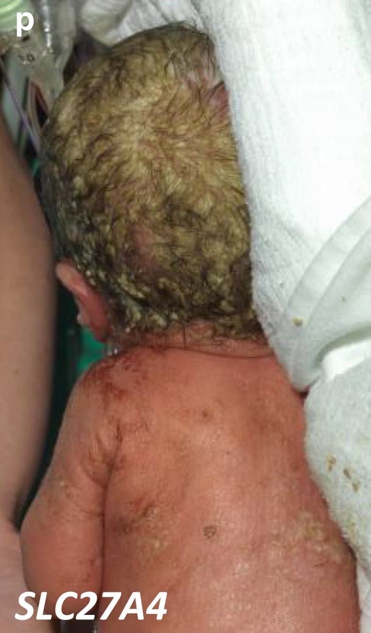 SLC27A4-nEDD: this neonate was born prematurely weighing 1990g after ultrasound evaluation in the second trimester of pregnancy showed polyhydramnios. Severe respiratory distress was noted at birth and at day 1 of age, the thick caseous desquamating skin was noted on scalp, back and extremities.