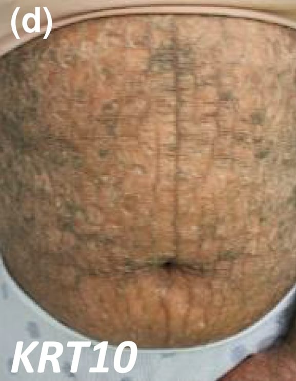 KRT10-nEDD-epidermolytic: large corrugated dark scaling in a patient with skin of colour.
