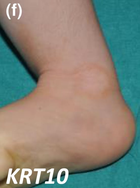 KRT10-nEDD-annular: annular scaly plaque on the inner left ankle. These lesions show superficial epidermolysis and are often transient.