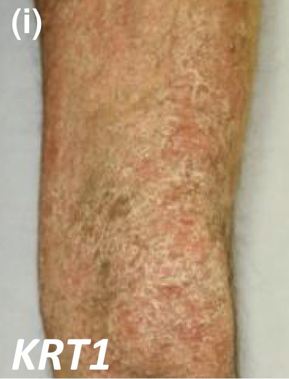 KRT1-nEDD-epidermolytic: diffuse severe scaling and skin thickening on the thigh of an adult.