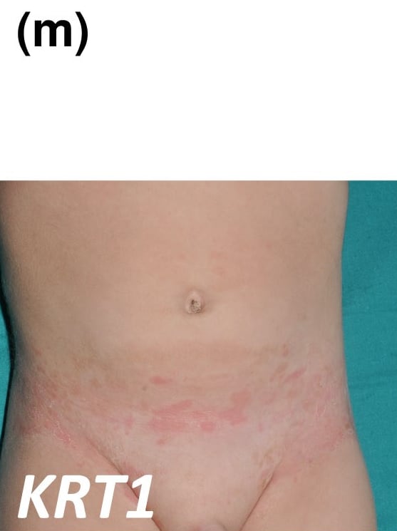KRT1-nEDD-annular: annular superficial erythematous and scaly lesions on the lower abdomen, typically transient.