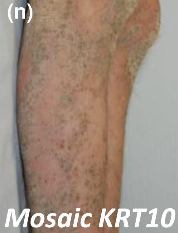 KRT-nEDD-mosaic: KRT10-nEDD-mosaic: severe grey skin thickening on the legs, following the lines of Blaschko.