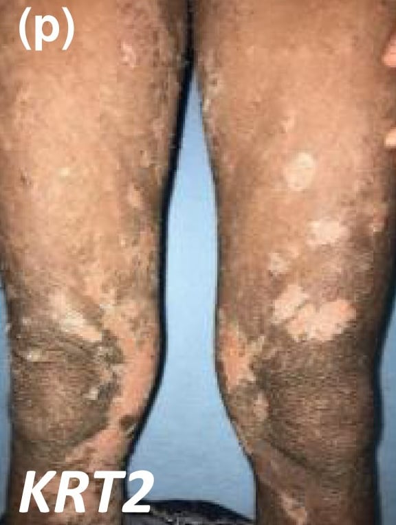 KRT2-nEDD: diffuse thickening of the skin with areas of superficial detachment in a patient with a darker skin phototype. This typical appearance is due to the presence of epidermolysis in the upper layers of the stratum corneum.