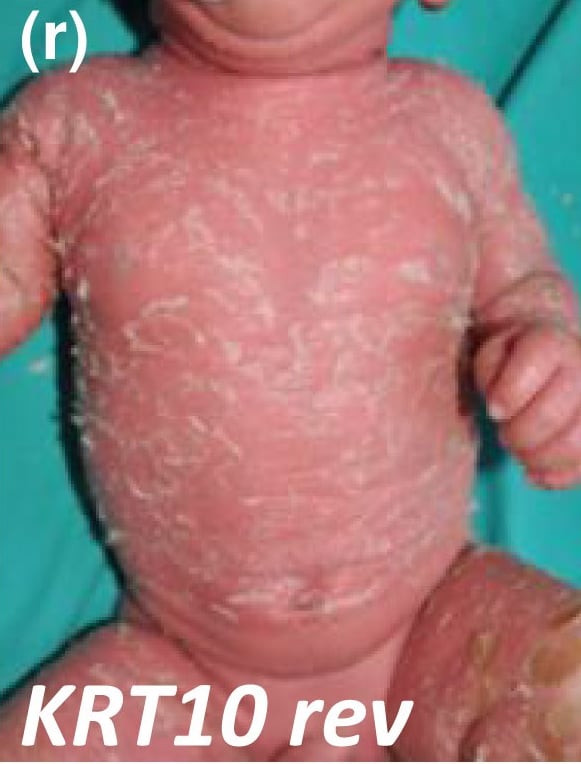 KRT-nEDD-revertant mosaic: KRT10-nEDD-revertant (rev) mosaic: severe erythroderma with large, superficial scaling in a newborn baby with this condition (formerly known as ichthyosis with confetti).