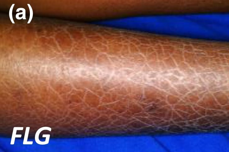 FLG-nEDD: darker polygonal scaling is most pronounced on the lower leg in this patient with skin of colour.
