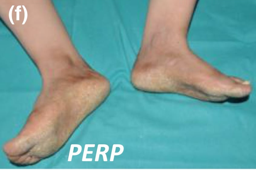 PERP-nEDD-AR: diffuse and rough thickening of the soles extending to the lateral aspects of the feet (classically referred to as transgrediens). Note the onychodystrophy of the first toenail on the left foot, as well as diffuse dark hyperpigmentation in the adjacent areas.