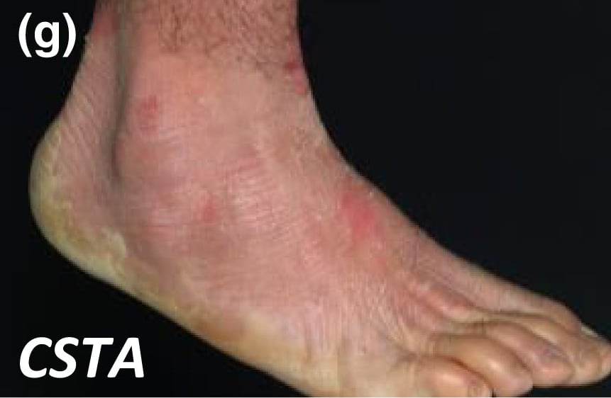 CSTA-nEDD: superficial peeling of the skin and erythema on the dorsum of the foot.