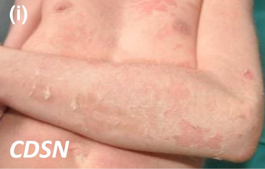 CDSN-nEDD: diffuse erythema and superficial peeling of the skin leaving patchy areas of more pronounced erythema.