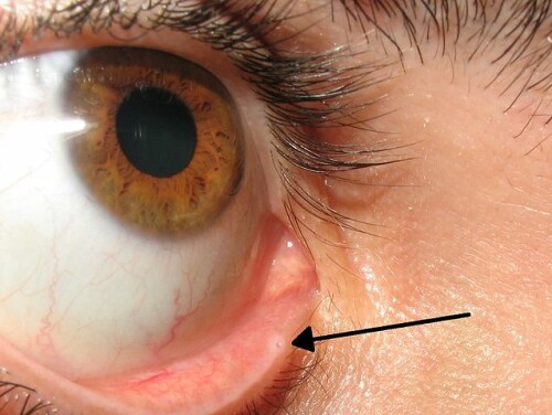 638px-Lacrimal_punctum.jpg