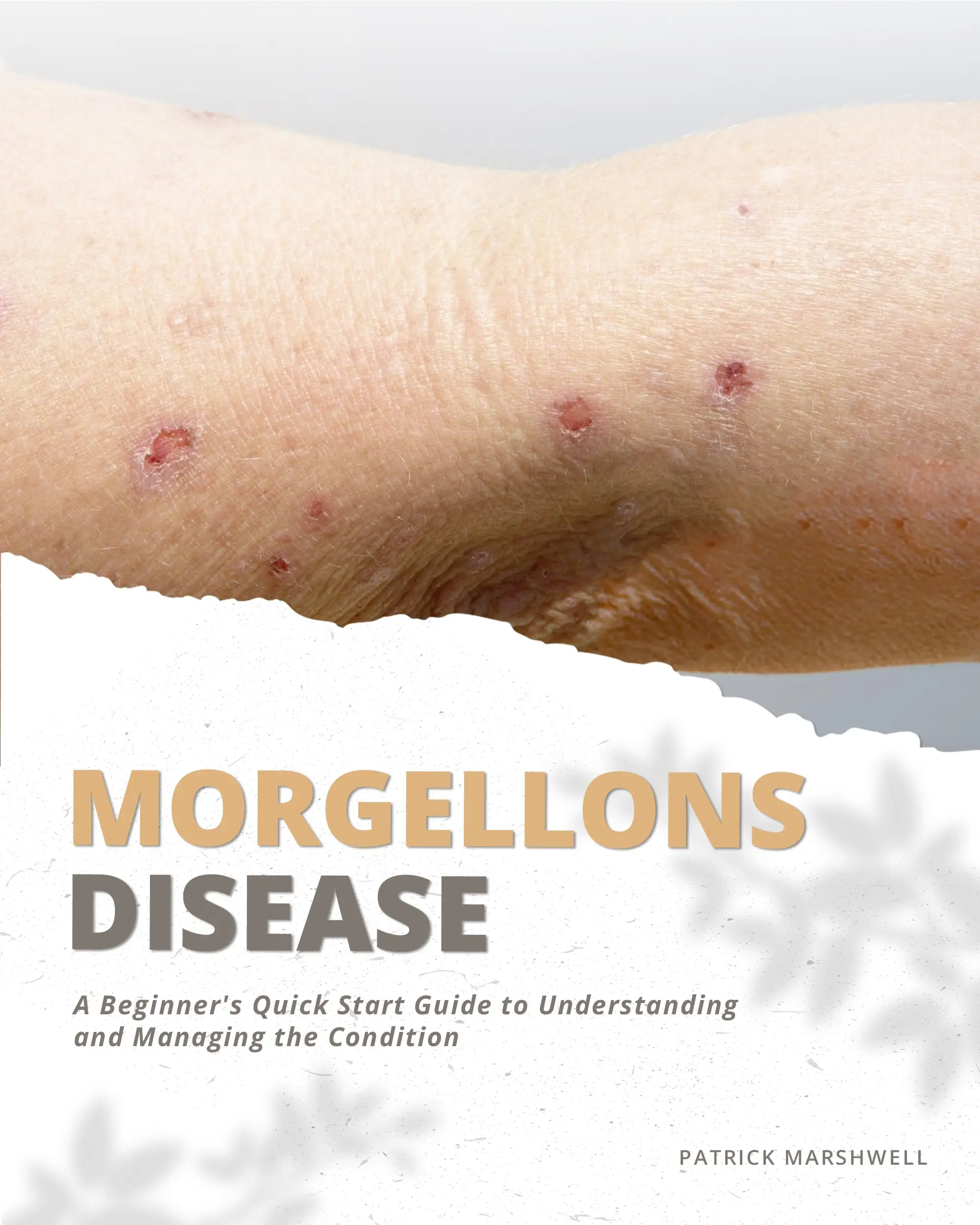 Morgellons Disease