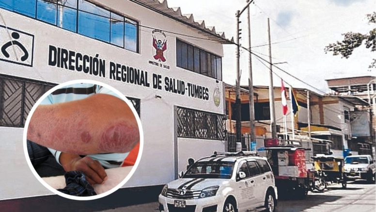 Detectan caso de lepra en Tumbes