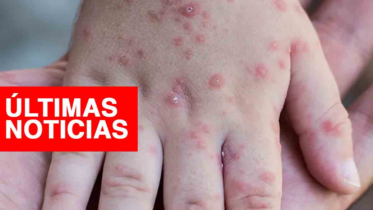 Coxsackie en Perú EN VIVO últimas noticias sobre los casos del virus