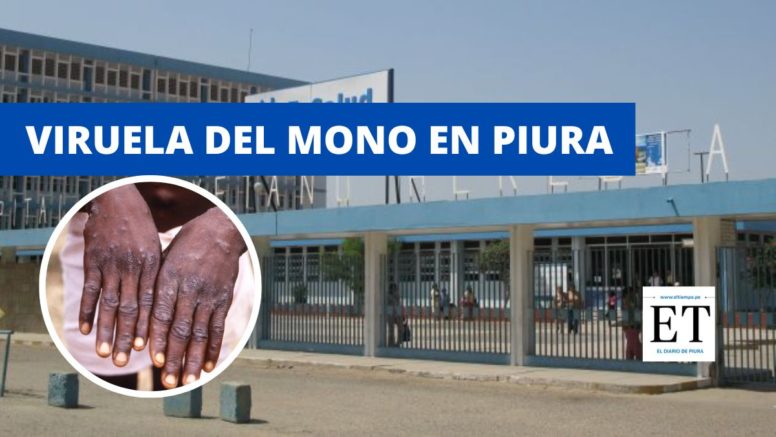 Diresa confirma el primer caso de viruela del mono en la región Piura