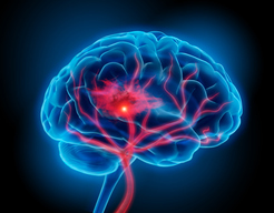 PKC Inhibition to Allow Extended tPA Treatment for Stroke