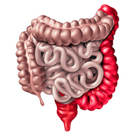 Gastrointestinal (GI) Locally-Activating JAK Inhibitor for Treatment of Ulcerative Colitis